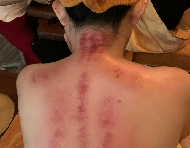 Trị Liệu Đau Mỏi Cổ Vai Gáy Tại Dĩ An – An Nhiên Spa