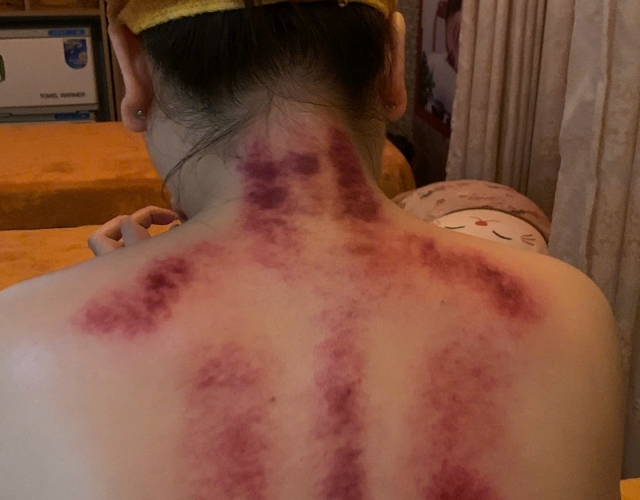 Trị Liệu Cổ Vai Gáy Hiệu Quả Tại An Nhiên Spa – Địa Chỉ Vàng Ở Dĩ An