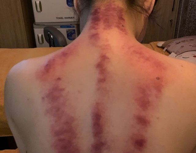 Trị Liệu Cổ Vai Gáy Tại Dĩ An – An Nhiên Spa 82 Đường Tân Long