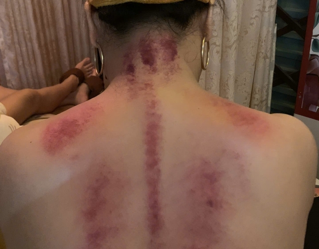 Trị Liệu Cổ Vai Gáy Chuyên Sâu Tại 82 Tân Long, Dĩ An – An Toàn & Hiệu Quả