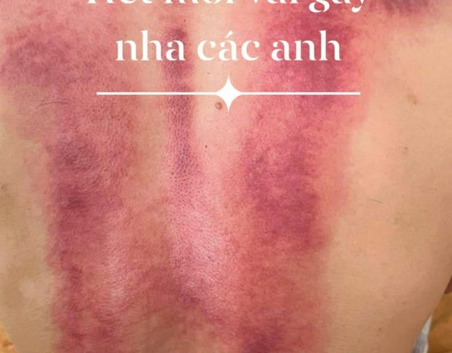 An Nhiên Spa 82 Tân Long – Chuyên Trị Liệu Cổ Vai Gáy Tại Dĩ An