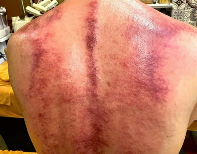 Trị Liệu Cổ Vai Gáy Hiệu Quả Tại An Nhiên Spa – Địa Chỉ Uy Tín Ở Dĩ An