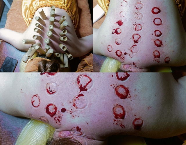 Phương Pháp Trị Liệu Đau Mỏi Cổ Vai Gáy Tại Dĩ An, Bình Dương: Hiệu Quả Sau 1 Liệu Trình