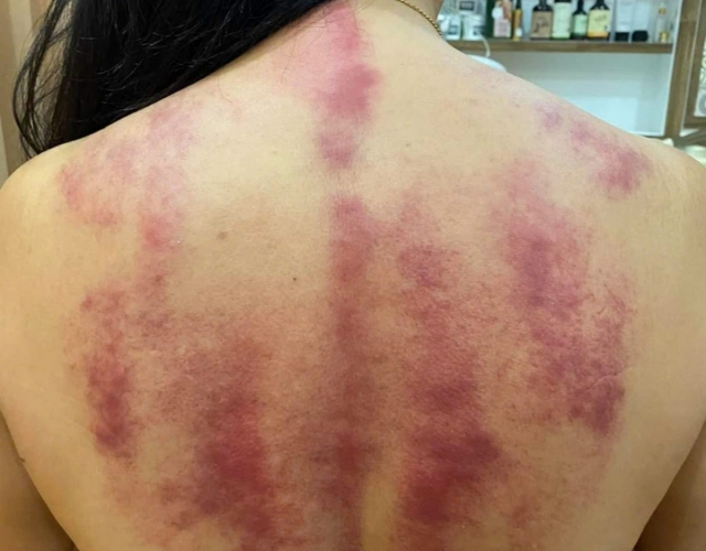 Trị Liệu Cổ Vai Gáy Chuyên Sâu Tại An Nhiên Spa Dĩ An – Phù Hợp Mọi Đối Tượng