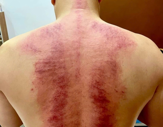 An Nhiên Spa – Liệu Trình Chuyên Sâu Cho Đau Mỏi Cổ Vai Gáy Ở Dĩ An