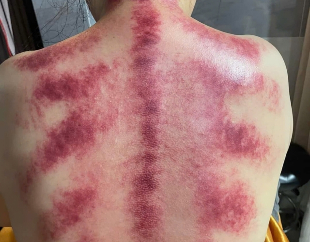 Dịch Vụ Trị Liệu Cổ Vai Gáy Hàng Đầu Tại Dĩ An – An Nhiên Spa