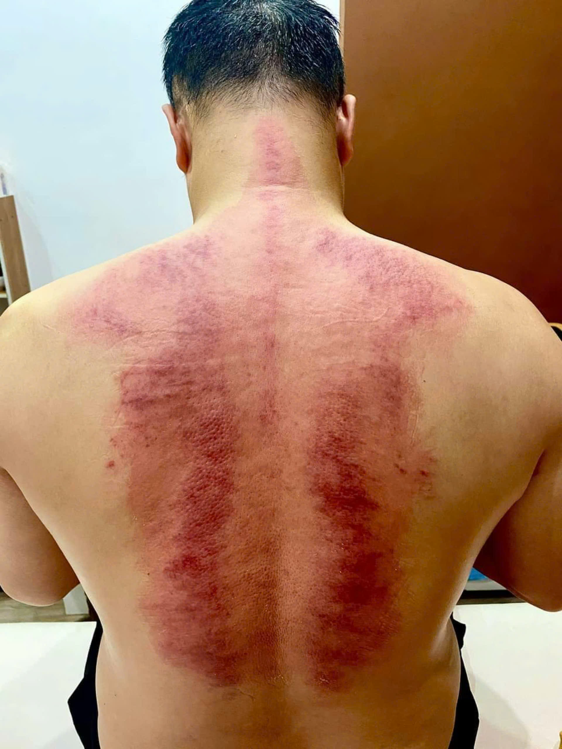 trị liệu đau vai gáy