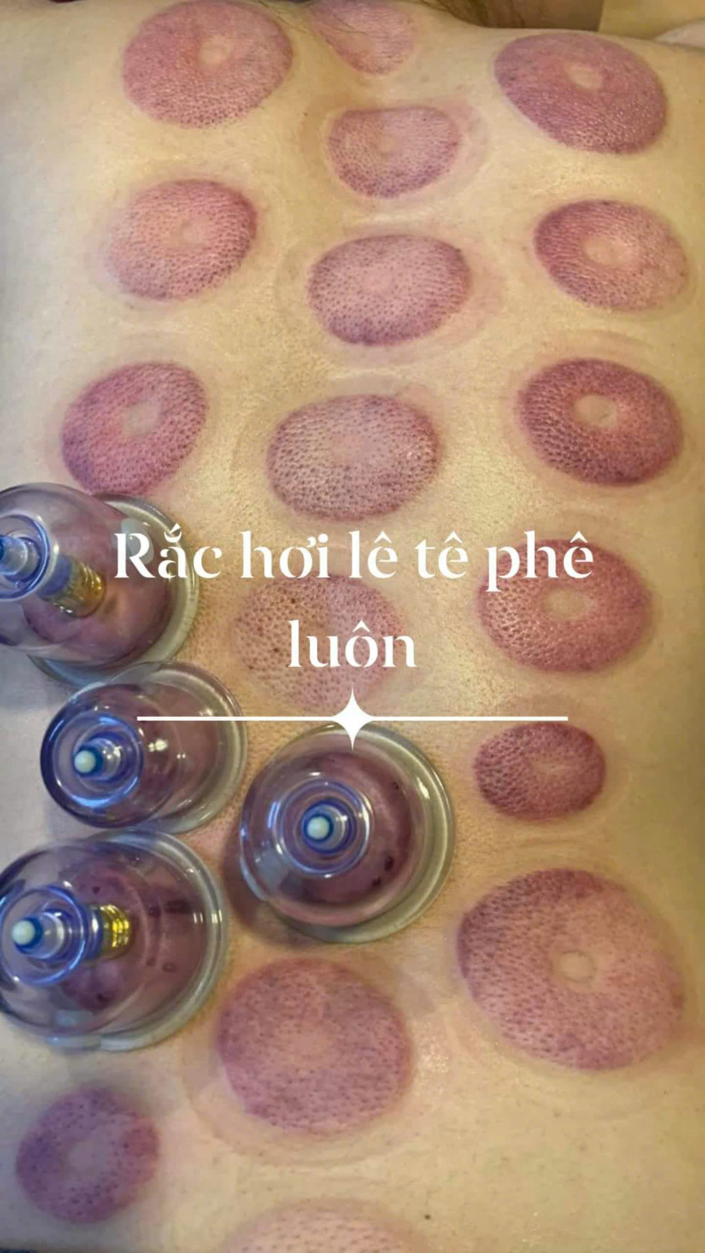trị liệu vai gáy