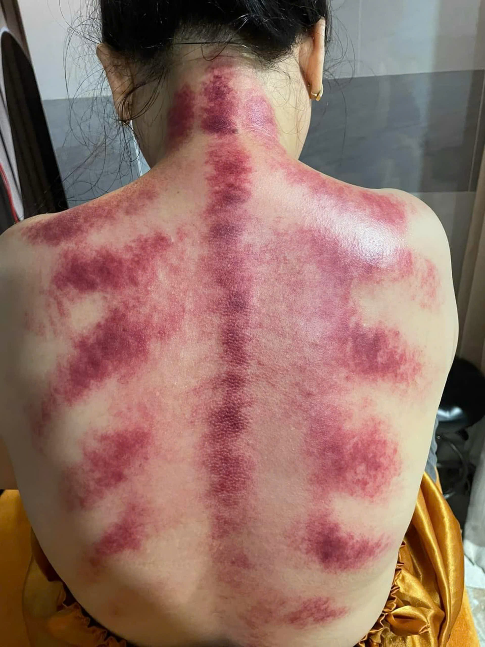 trị liệu đau mỏi vai gáy 