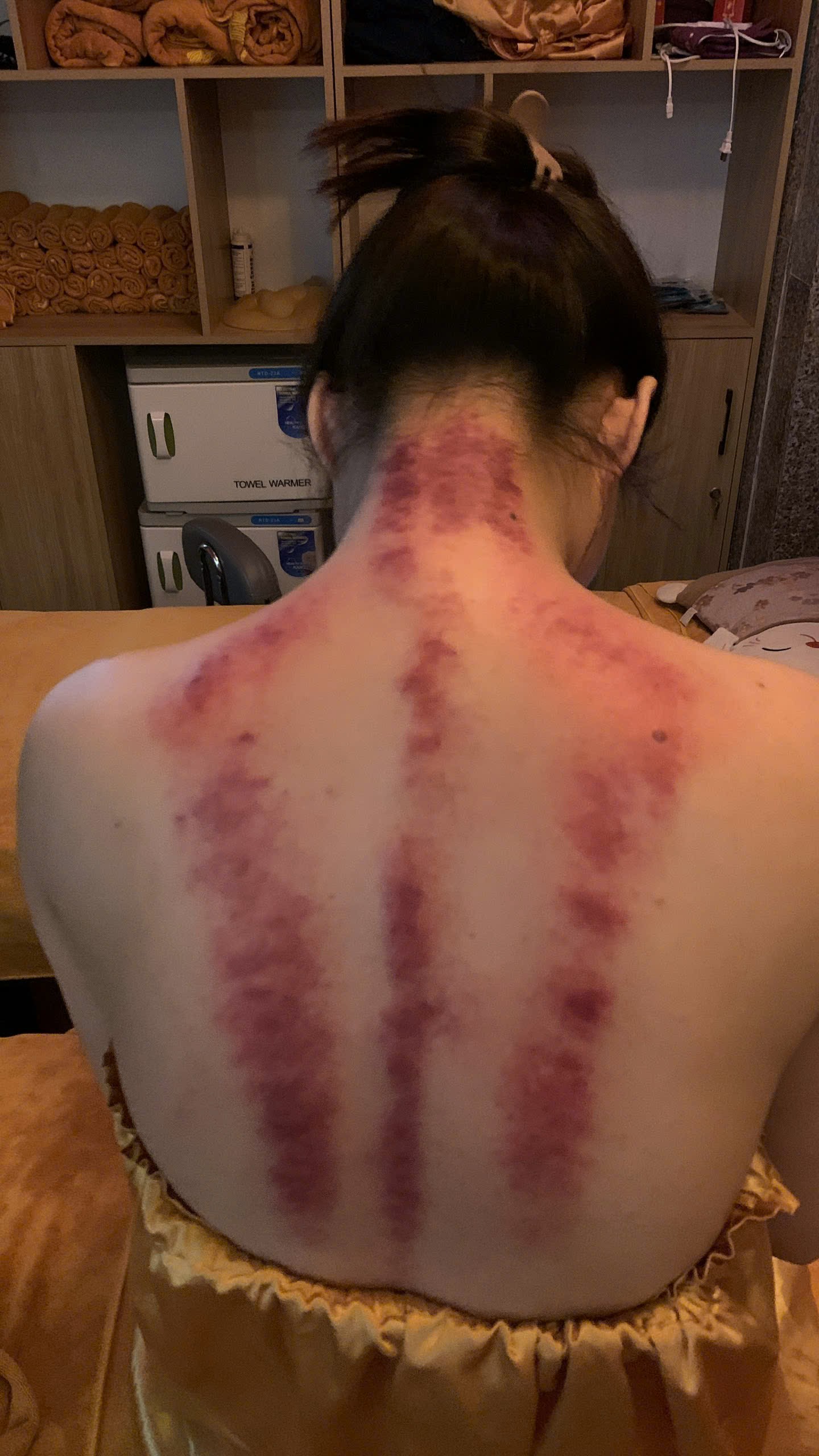 trị liệu vai gáy
