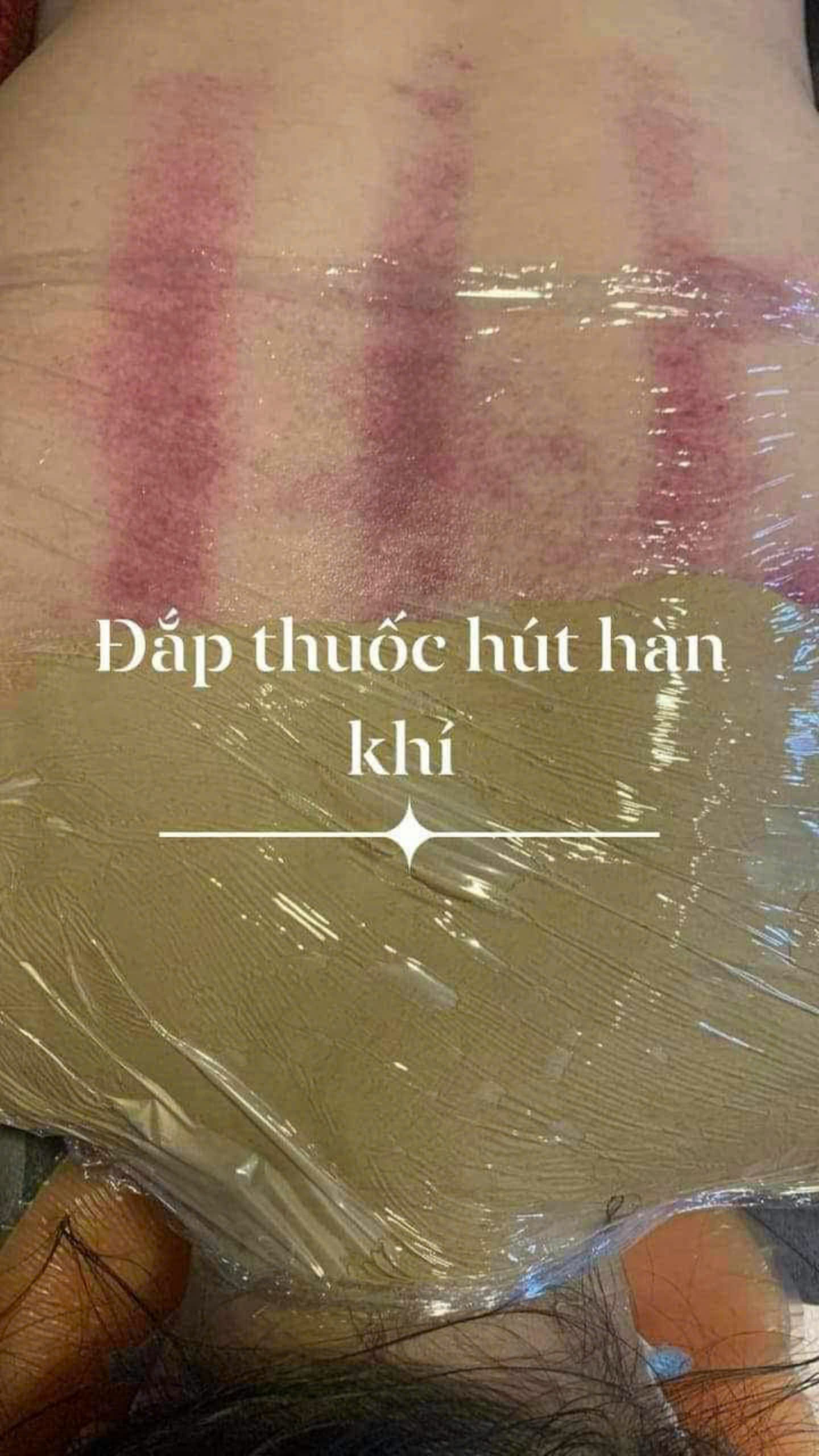 trị liệu đau mỏi vai gáy