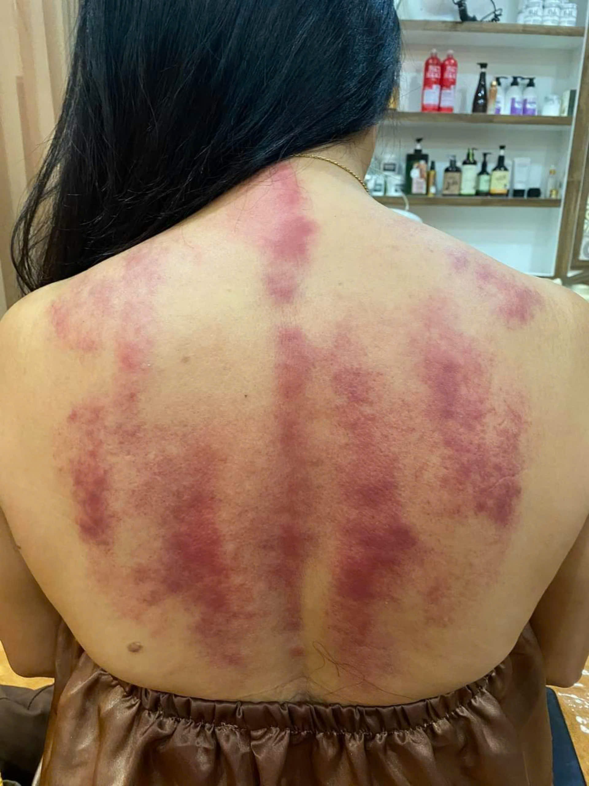 trị liệu vai gáy 